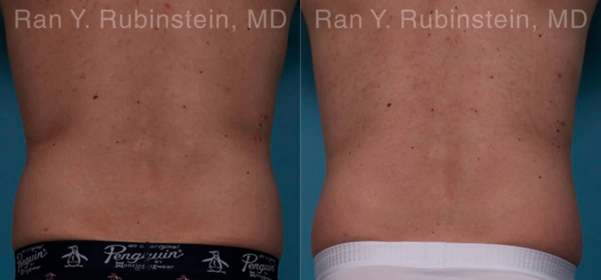 Coolsculpting Elite Before and After Photos in Newburgh, NY, Patient 18079