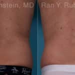 Coolsculpting Elite Before and After Photos in Newburgh, NY, Patient 18079