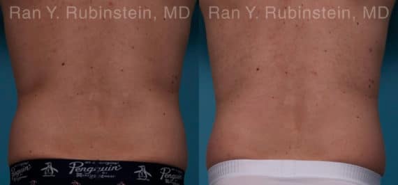 Coolsculpting Elite Before and After Photos in Newburgh, NY, Patient 18079