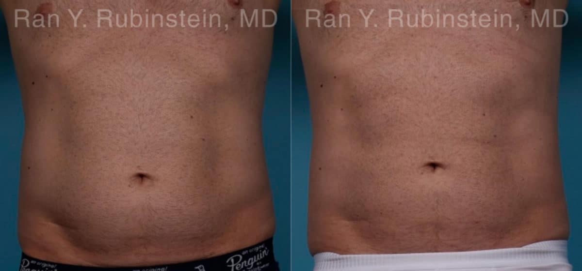 Coolsculpting Elite Before and After Photos in Newburgh, NY, Patient 18079