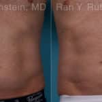 Coolsculpting Elite Before and After Photos in Newburgh, NY, Patient 18079