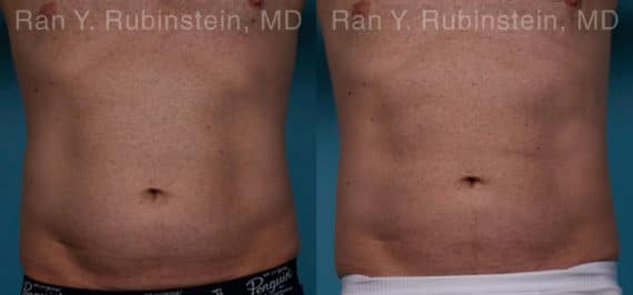 Coolsculpting Elite Before and After Photos in Newburgh, NY, Patient 18079