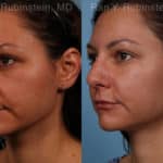 Sculptra Face Before and After Photos in Newburgh, NY, Patient 18419