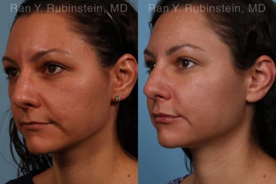 Sculptra Face Before and After Photos in Newburgh, NY, Patient 18419