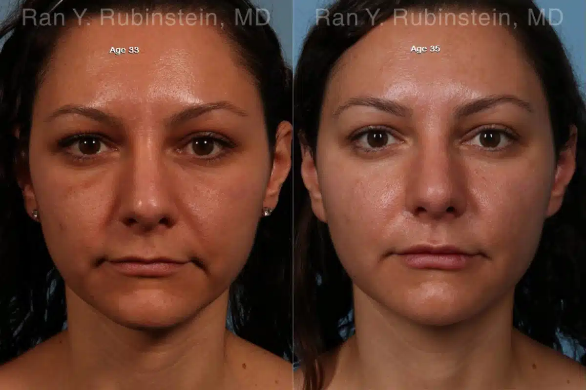 Sculptra Face Before and After Photos in Newburgh, NY, Patient 18419