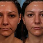 Sculptra Face Before and After Photos in Newburgh, NY, Patient 18419