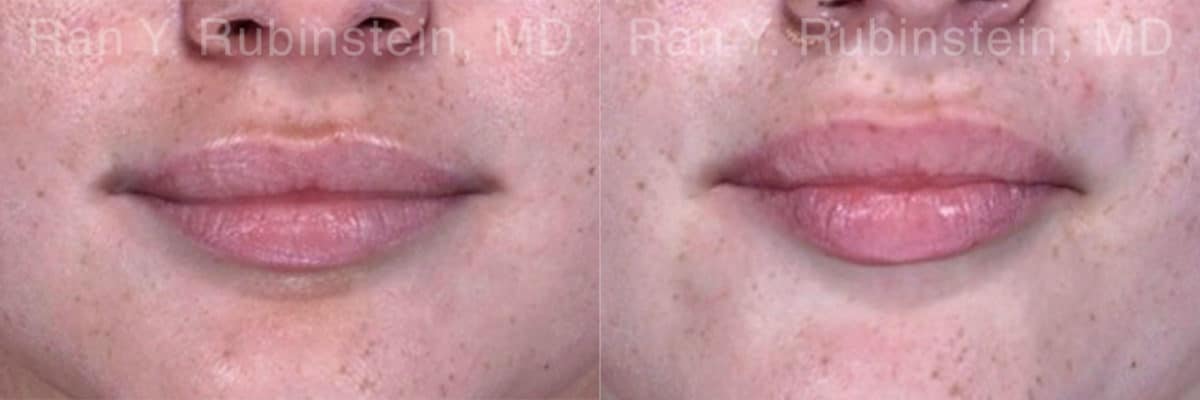 Lip Fillers Before and After Photos in Newburgh, NY, Patient 18436