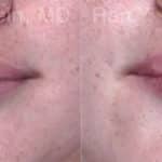 Lip Fillers Before and After Photos in Newburgh, NY, Patient 18436