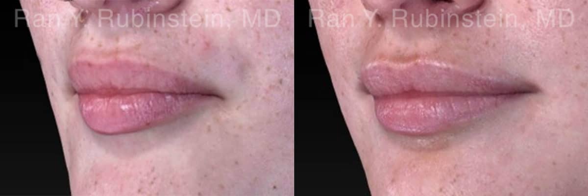 Lip Fillers Before and After Photos in Newburgh, NY, Patient 18436