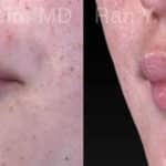 Lip Fillers Before and After Photos in Newburgh, NY, Patient 18436