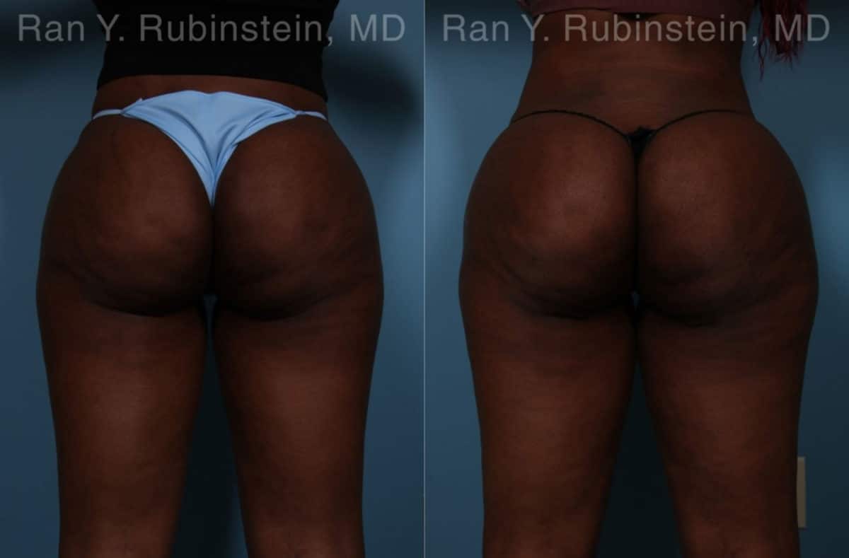 Sculptra Butt Lift Before and After Photos in Newburgh, NY, Patient 18453