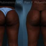 Sculptra Butt Lift Before and After Photos in Newburgh, NY, Patient 18453