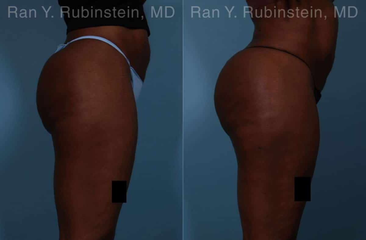 Sculptra Butt Lift Before and After Photos in Newburgh, NY, Patient 18453