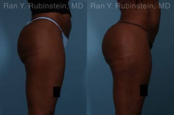 Sculptra Butt Lift Before and After Photos in Newburgh, NY, Patient 18453