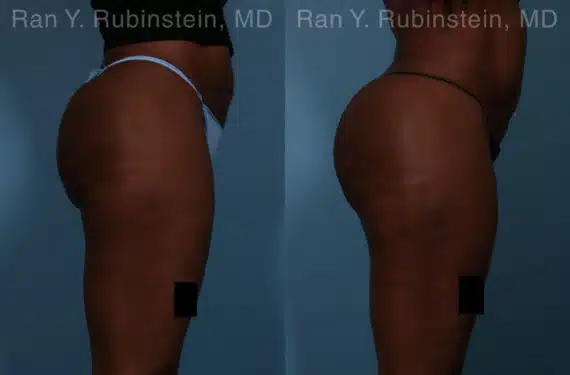 Sculptra Butt Lift Before and After Photos in Newburgh, NY, Patient 18453