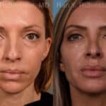 Sculptra Face Before and After Photos in Newburgh, NY, Patient 18887