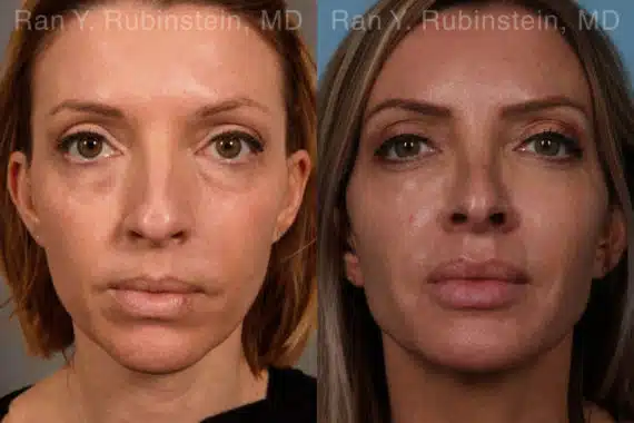 Sculptra Face Before and After Photos in Newburgh, NY, Patient 18887