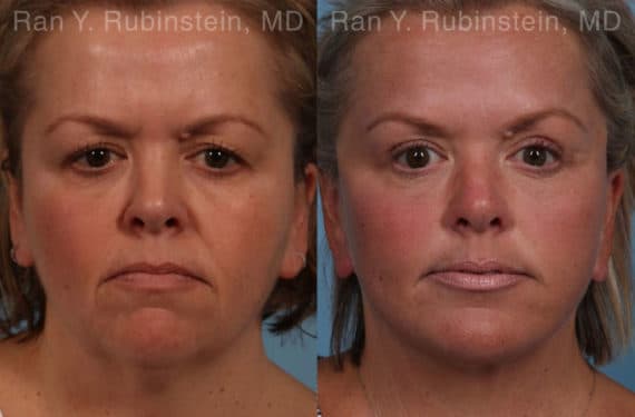 Face lift & Neck lift Before and After Photos in Newburgh, NY, Patient 18958