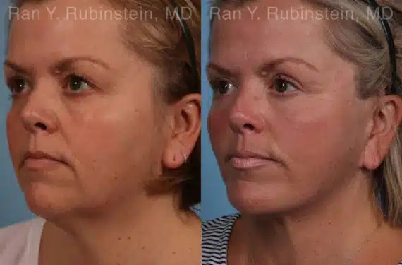 Face lift & Neck lift Before and After Photos in Newburgh, NY, Patient 18958