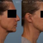 Face lift & Neck lift Before and After Photos in Newburgh, NY, Patient 18962