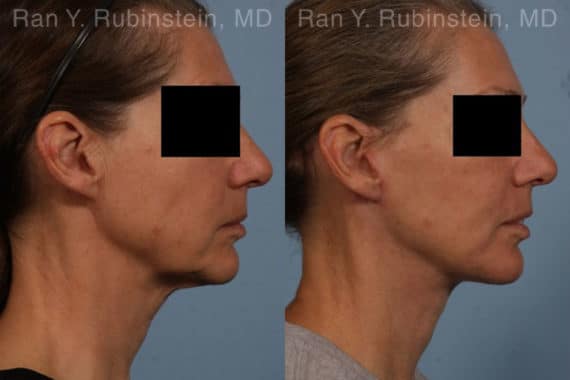 Face lift & Neck lift Before and After Photos in Newburgh, NY, Patient 18962