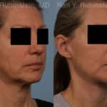 Face lift & Neck lift Before and After Photos in Newburgh, NY, Patient 18962