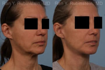 Face lift & Neck lift Before and After Photos in Newburgh, NY, Patient 18962