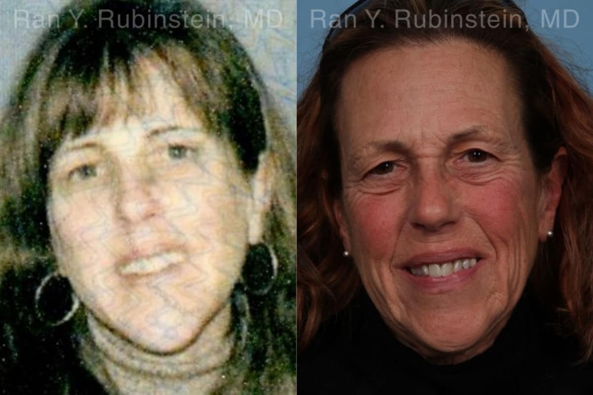 Dermal Fillers Before and After Photos in Montvale, NJ, Patient 18993
