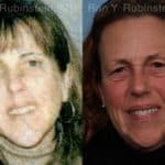 Dermal Fillers Before and After Photos in Newburgh, NY, Patient 18993