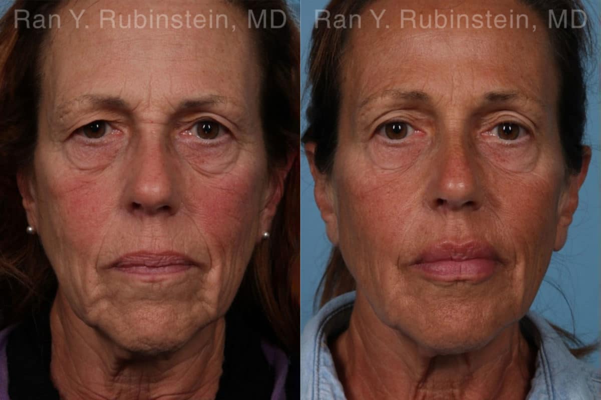 Dermal Fillers Before and After Photos in Newburgh, NY, Patient 18993