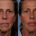 Dermal Fillers Before and After Photos in Newburgh, NY, Patient 18993