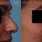 Non-Surgical Rhinoplasty Before and After Photos in Newburgh, NY, Patient 19009