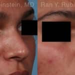 Non-Surgical Rhinoplasty Before and After Photos in Newburgh, NY, Patient 19009