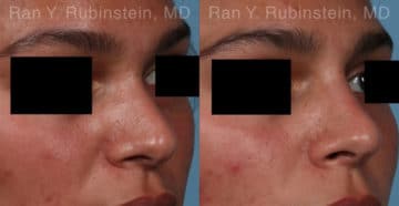 Non-Surgical Rhinoplasty Before and After Photos in Newburgh, NY, Patient 19009