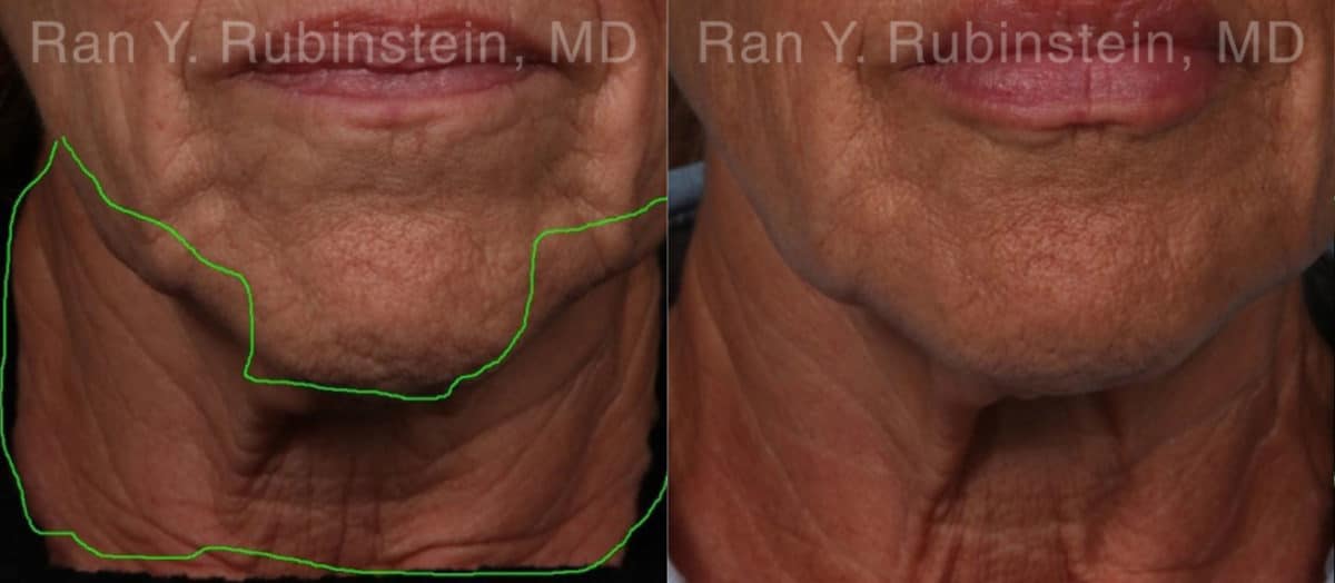 Botox Before and After Photos in Newburgh, NY, Patient 19026