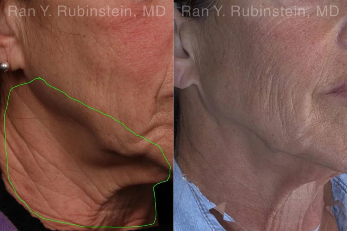 Botox Before and After Photos in Newburgh, NY, Patient 19026