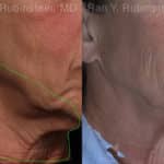 Botox Before and After Photos in Newburgh, NY, Patient 19026