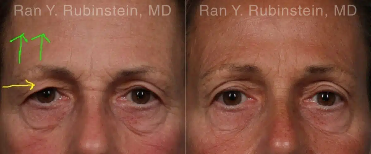 Botox Before and After Photos in Newburgh, NY, Patient 19033