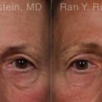 Botox Before and After Photos in Newburgh, NY, Patient 19033