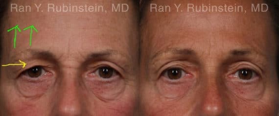 Botox Before and After Photos in Newburgh, NY, Patient 19033