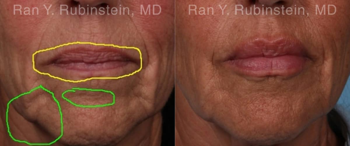 Lip Fillers Before and After Photos in Newburgh, NY, Patient 19037