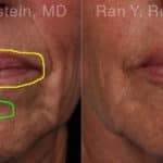 Lip Fillers Before and After Photos in Newburgh, NY, Patient 19037