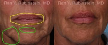 Lip Fillers Before and After Photos in Newburgh, NY, Patient 19037