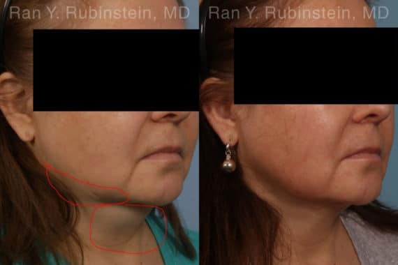 Laser Lift Precision Tx Before and After Photos in Newburgh, NY, Patient 19204