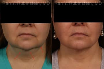 Laser Lift Precision Tx Before and After Photos in Newburgh, NY, Patient 19204