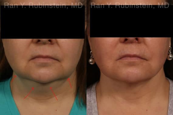 Laser Lift Precision Tx Before and After Photos in Newburgh, NY, Patient 19204