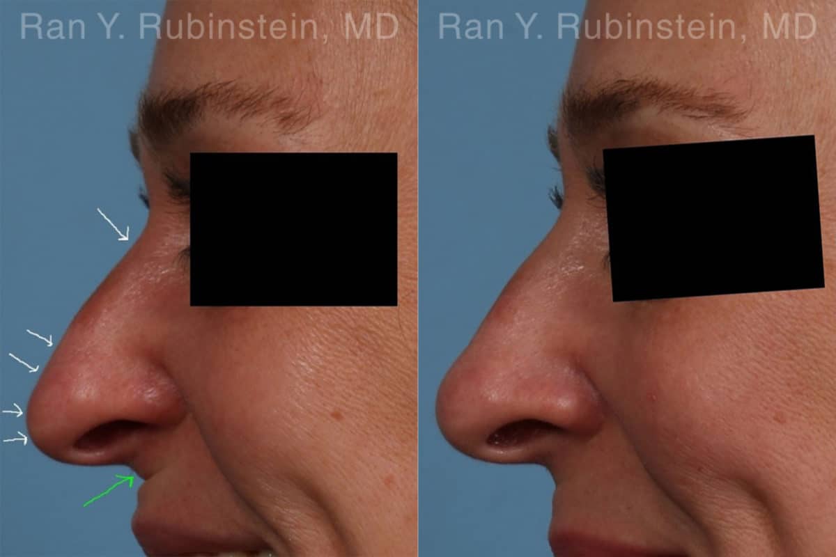 Non-Surgical Rhinoplasty Before and After Photos in Newburgh, NY, Patient 19263