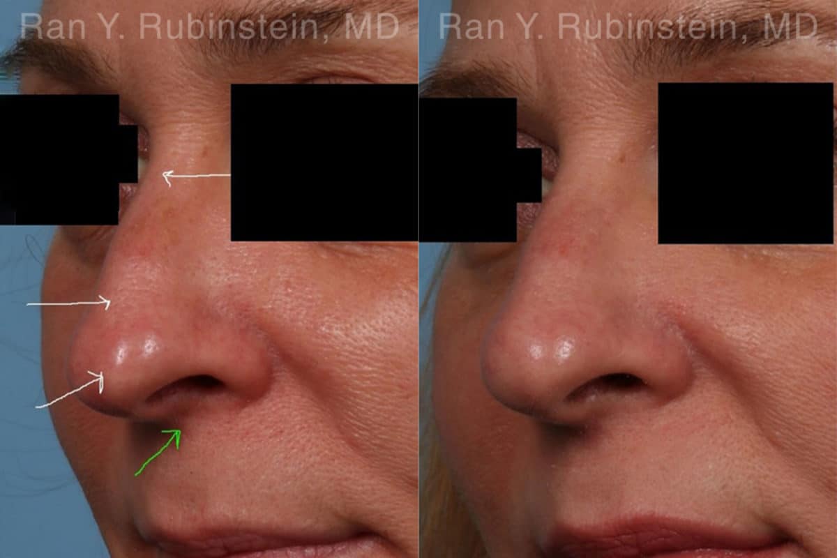 Non-Surgical Rhinoplasty Before and After Photos in Newburgh, NY, Patient 19263