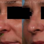 Non-Surgical Rhinoplasty Before and After Photos in Newburgh, NY, Patient 19263