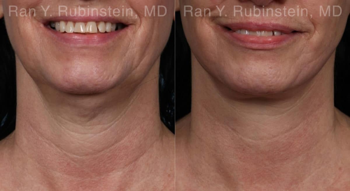 Face lift & Neck lift Before and After Photos in Newburgh, NY, Patient 19365